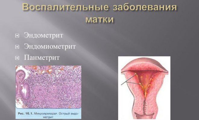 endometrit-3-e1490348532133-3499238