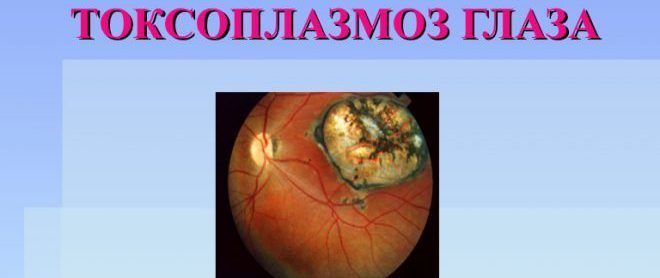 glaznoj-toksoplazmoz-u-detej-e1489049587754-2933003