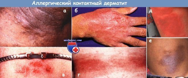 kontaktnyj-dermatit-e1488877735250-6851136