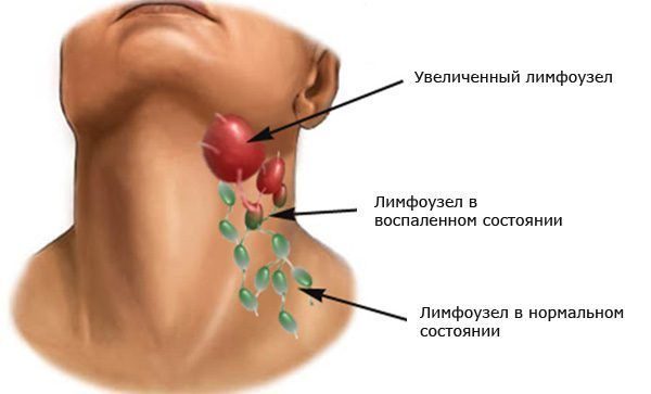 obsledovat-limfouzly-e1488803562313-3450447