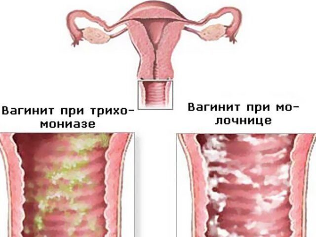 vaginit-9353602